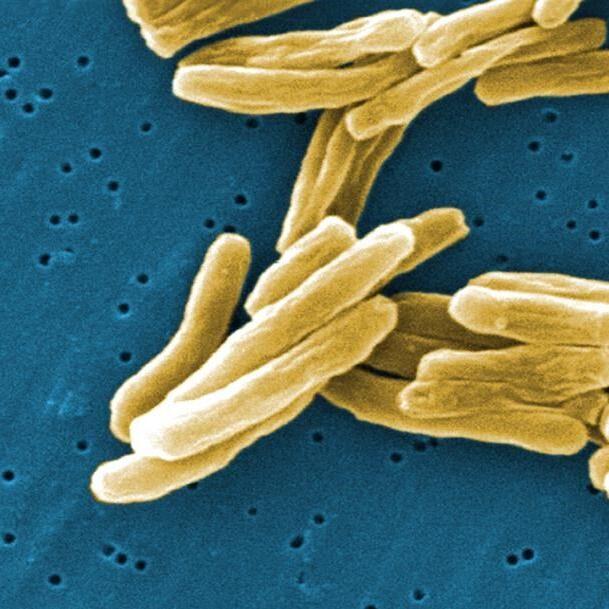 Active case of tuberculosis detected at University of Victoria